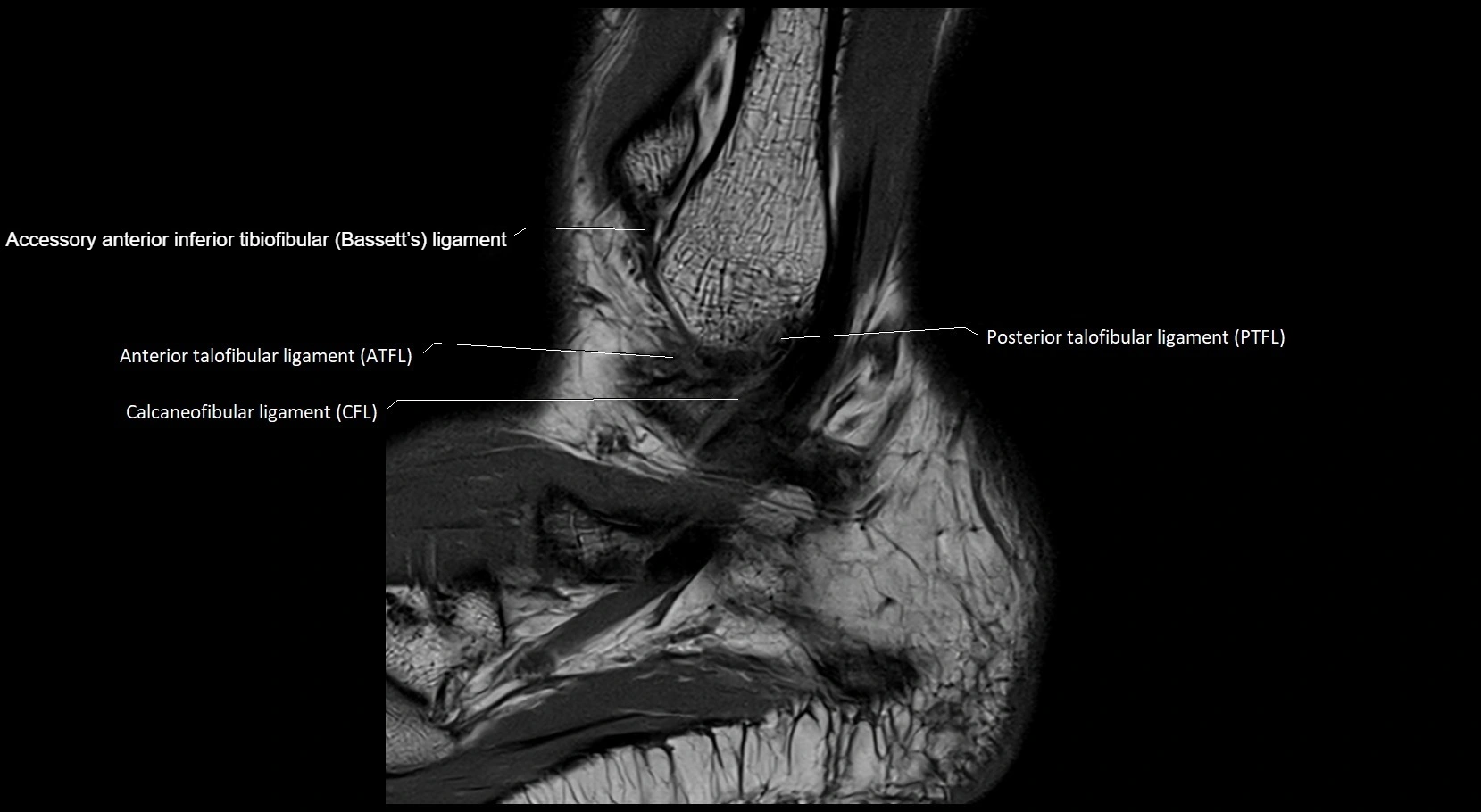 MRI ankle ligaments anatomy sagittal 3T image 24.webp